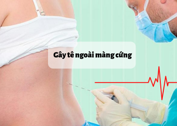 Ưu-nhược điểm của phương pháp gây tê màng cứng 135 Gây tê ngoài màng cứng - Medplus