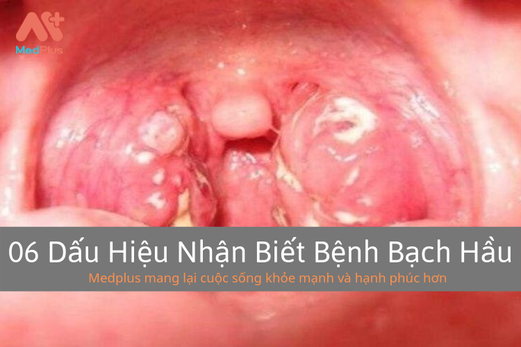 06 Dấu Hiệu Nhận Biết Bệnh Bạch Hầu 5 06 Dấu Hiệu Nhận Biết Bệnh Bạch Hầu