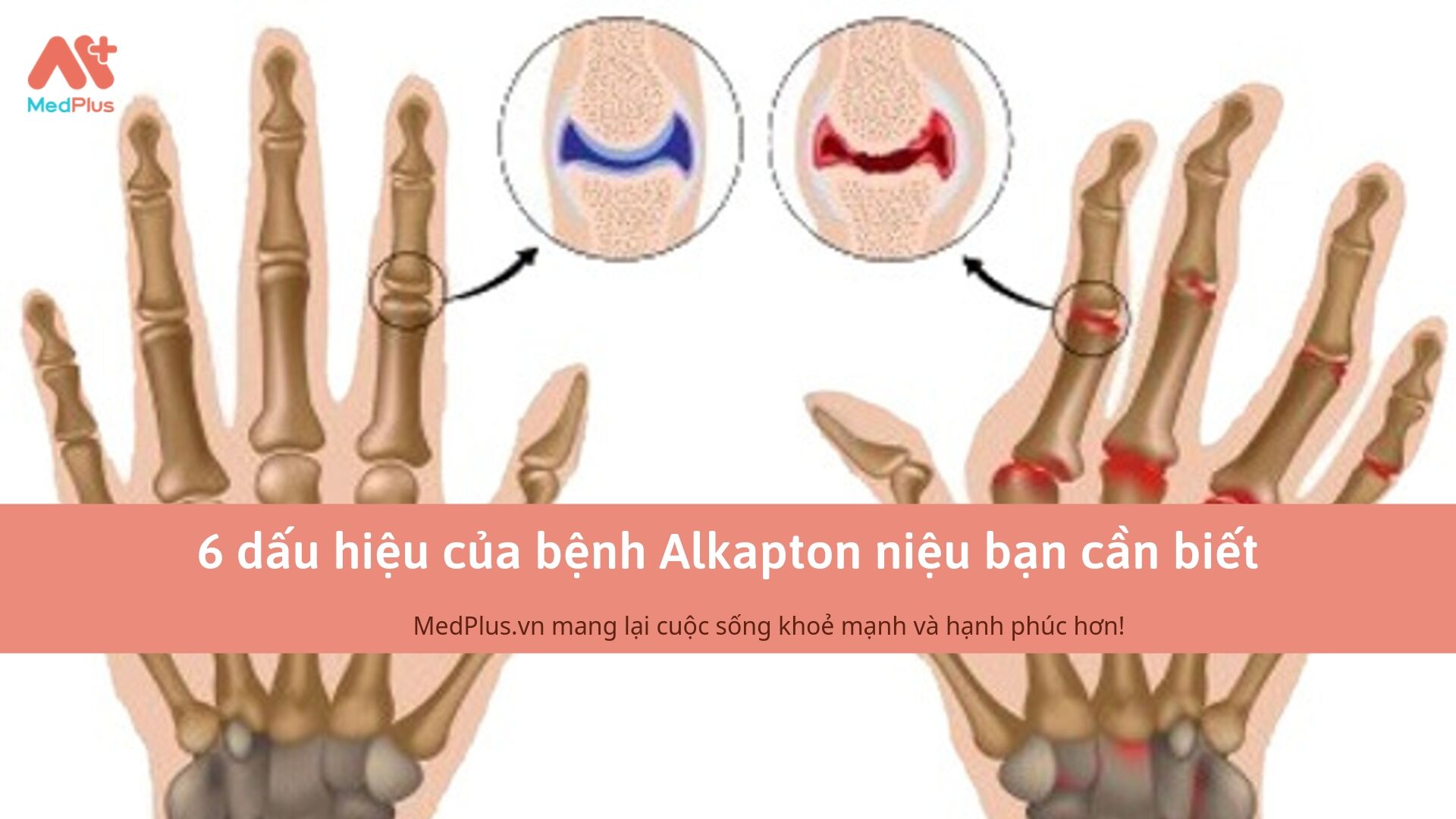 6 dấu hiệu của bệnh Alkapton niệu bạn cần biết