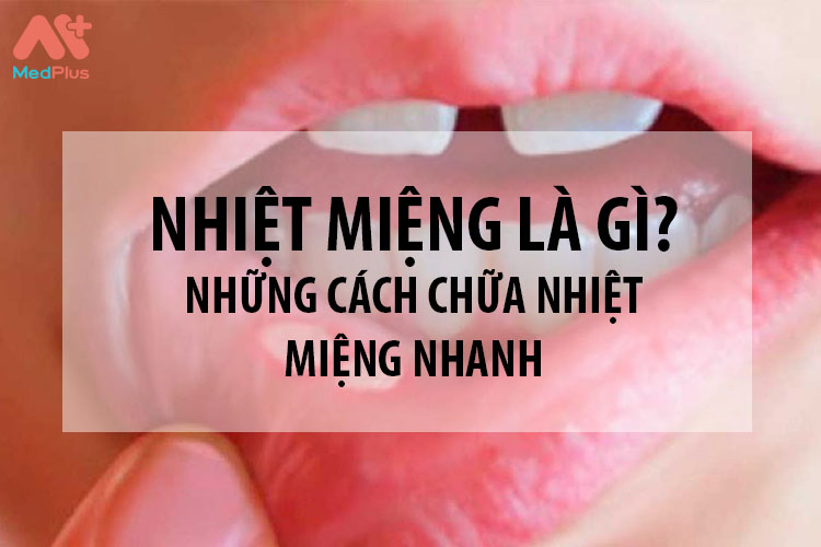 Nhiệt miệng là gì? Những cách thoát khỏi nhiệt miệng nhanh