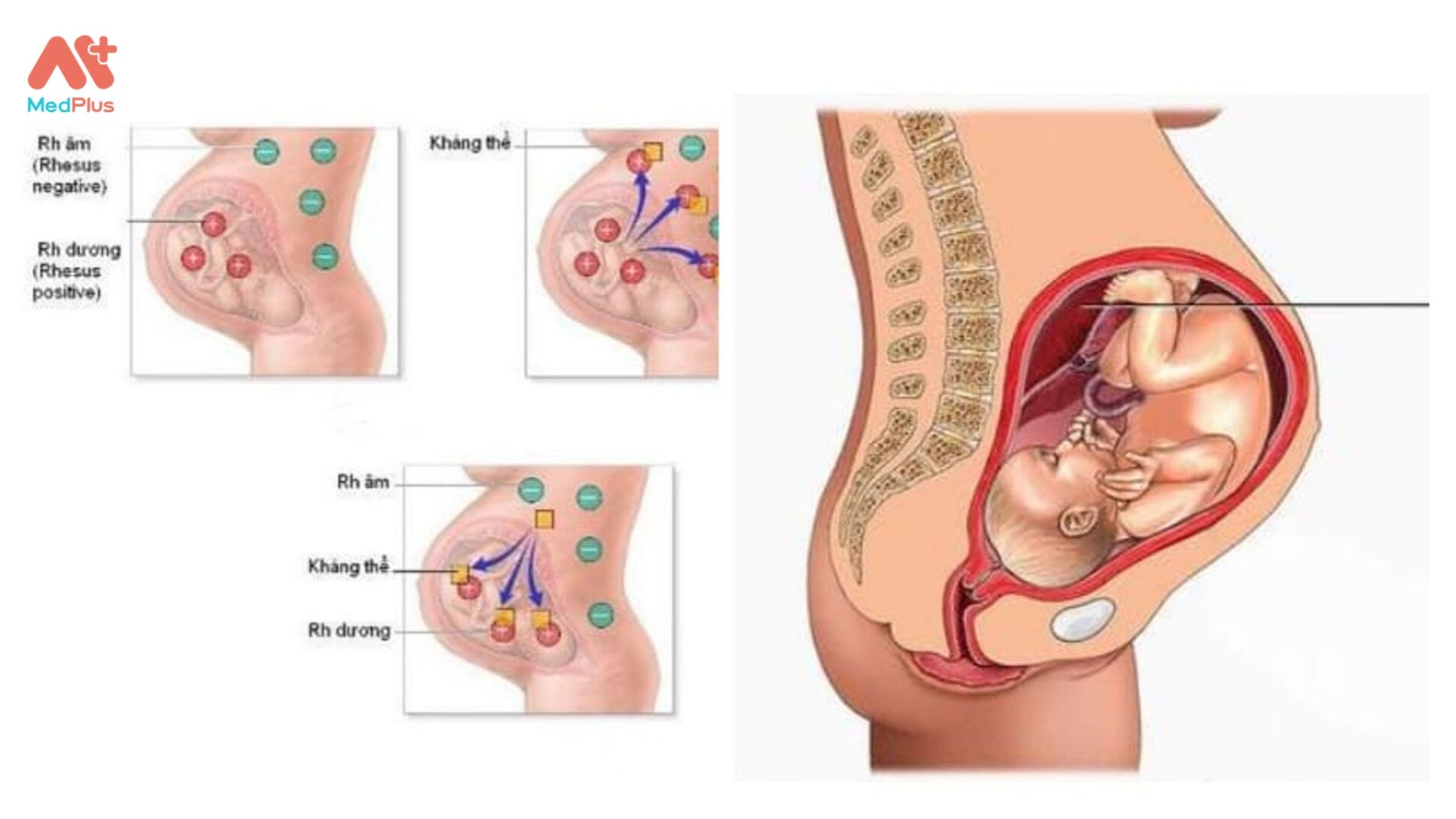 Xung đột nhóm máu làm cho cơ thể mẹ sản sinh kháng thể phá huỷ hồng cầu của bé