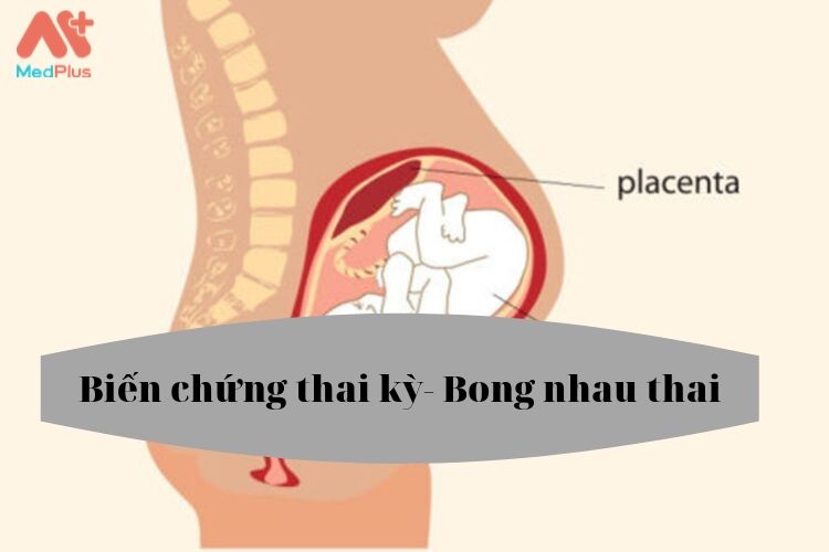 Biến chứng thai kỳ Bong nhau thai 1 - Medplus
