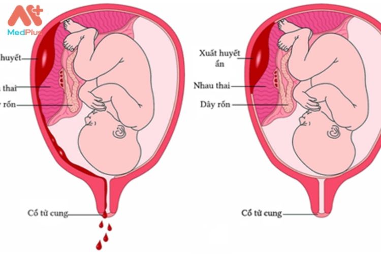 Biến chứng thai kỳ Bong nhau thai - Medplus