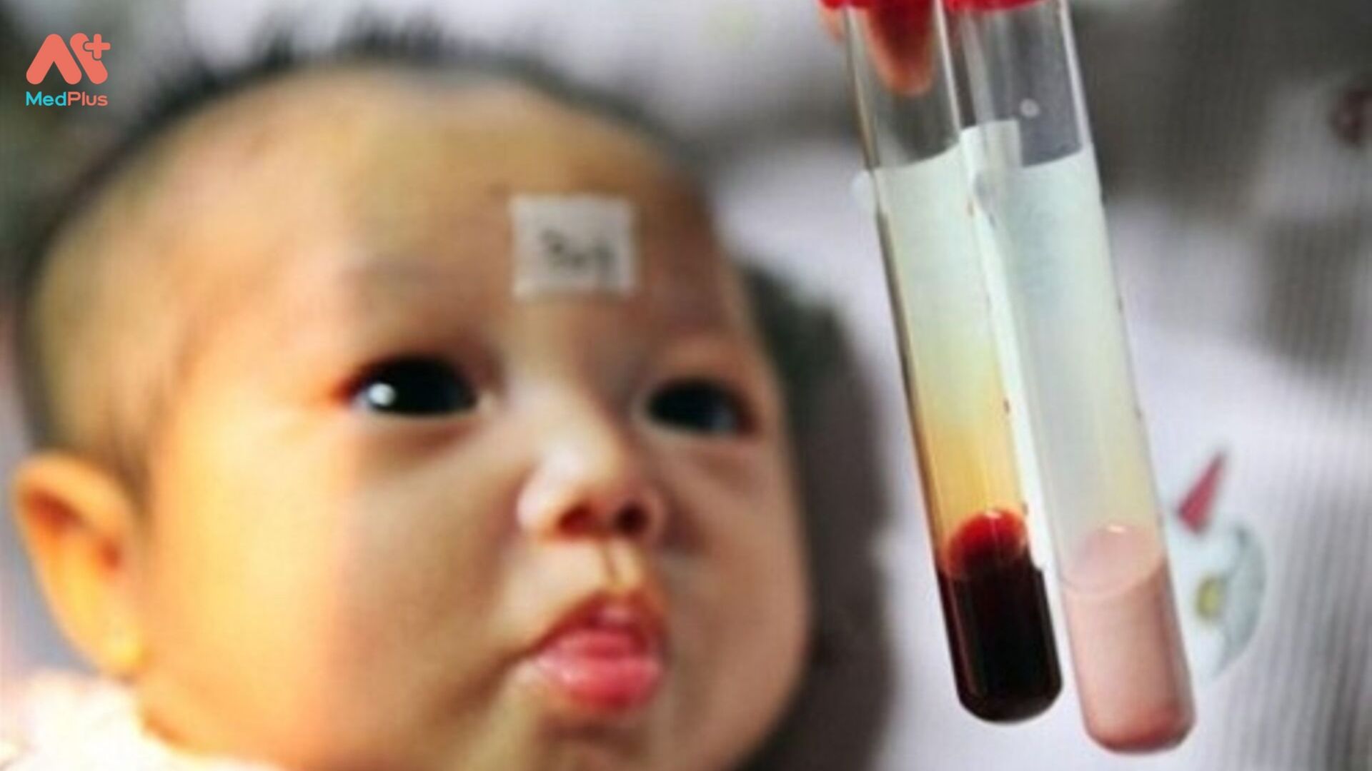 Bệnh tán huyết ở trẻ sơ sinh làm cho trẻ sinh ra bị thiếu máu và vàng da