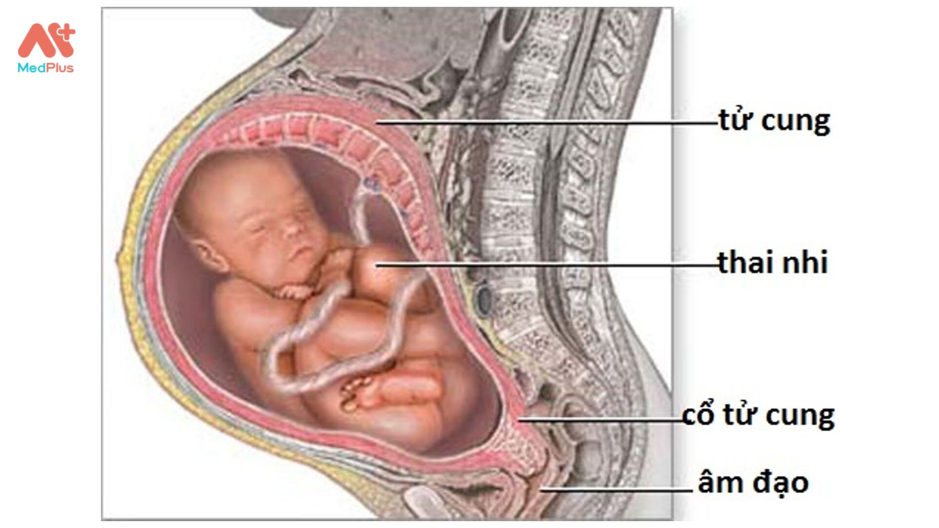 Đa ối có thể làm cho bé xoay ngôi mông thất thường, gây khó khăn cho việc sinh nở