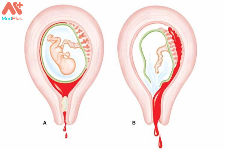 Vỡ tử cung là tình trạng tai biến sản khoa gây nguy hiểm đến sức khỏe mẹ và bé