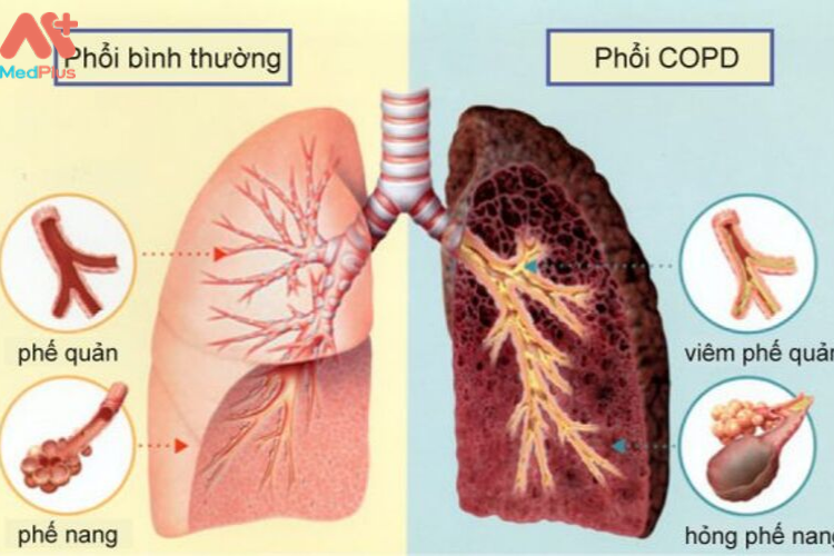 Các loại lao phổi