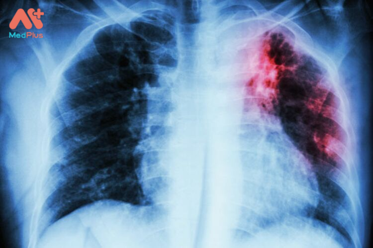 Lao phổi là một bệnh nguy hiểm