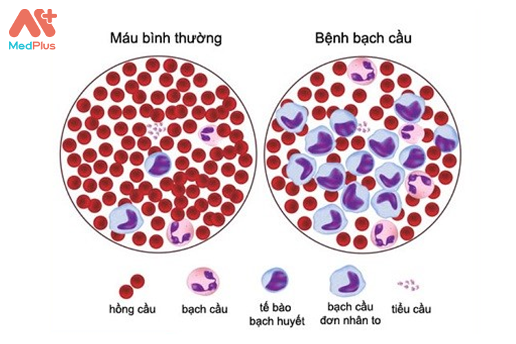 So sánh máu người bình thường và máu người bệnh bạch cầu