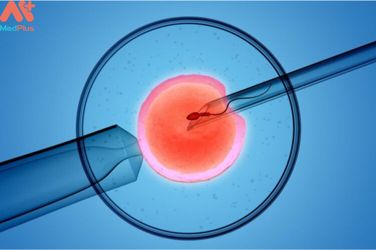 Trường hợp nào nên sử dụng phương pháp IVF để mang thai