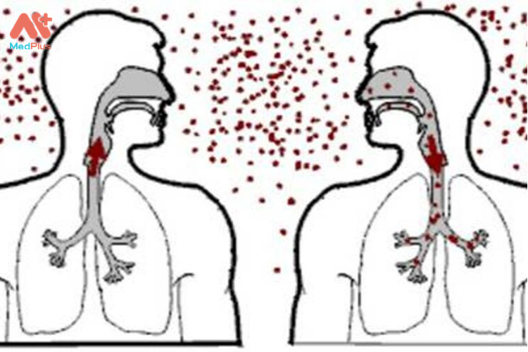 Tiếp xúc với người mắc bệnh lao phổi