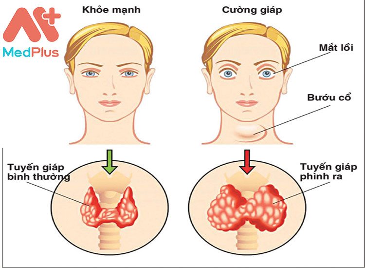 So sánh giữa một người bình thường và người suy giáp