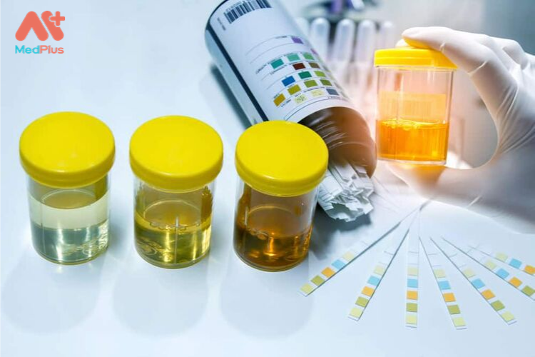 Xét nghiệm phân tích nước tiểu là phương pháp chẩn đoán quan trọng