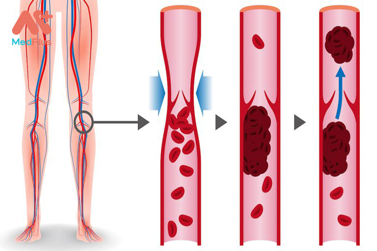 Các khối máu đông xuất hiện ở chi dưới gây cản trở lưu thông máu và sưng phù