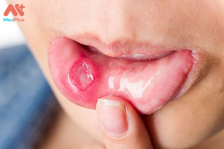 Nhiệt miệng là gì? Những cách thoát khỏi nhiệt miệng nhanh 130 Nhiệt miệng (loét miệng)
