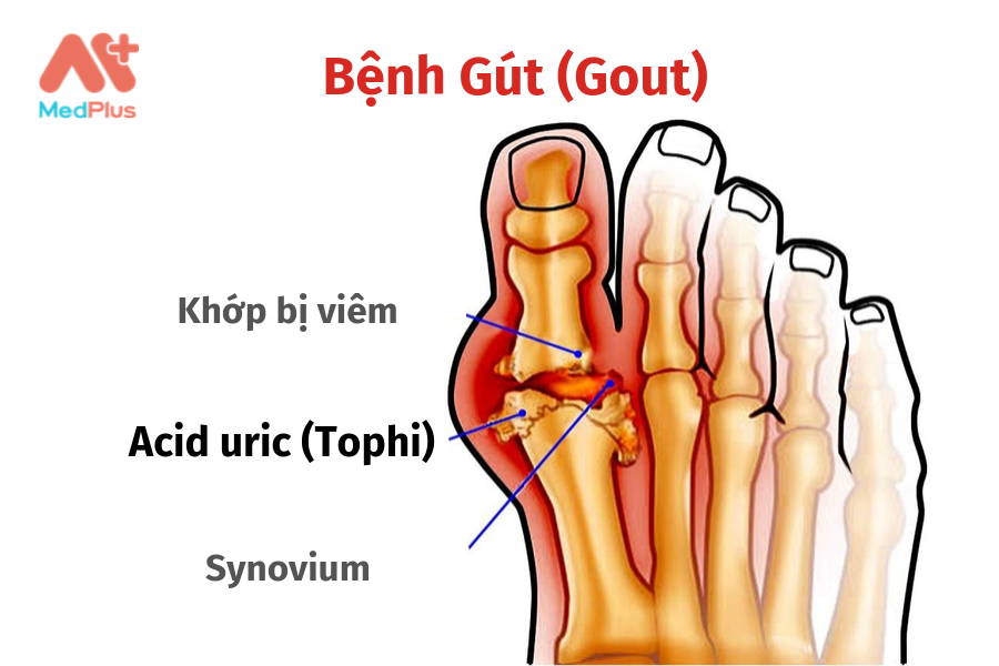 Bệnh gút thường xảy ra ở khớp đầu ngón chân