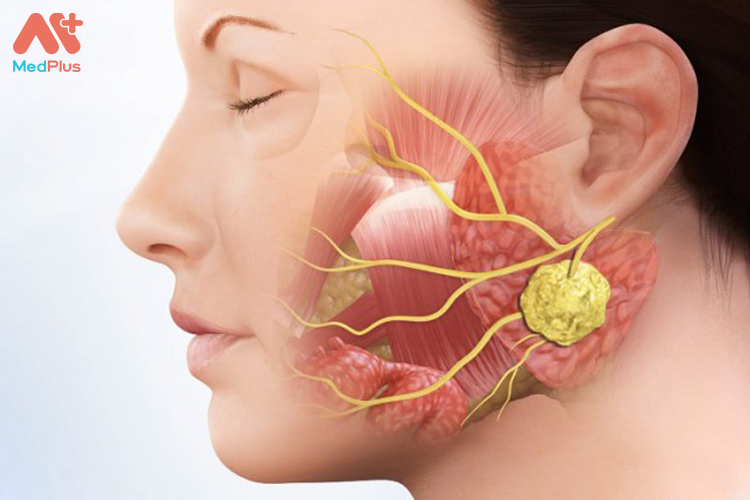 Cần điều trị viêm tuyến nước bọt
