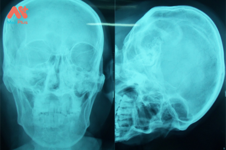 Chấn thương hàm mặt thường gặp ở phần mềm vùng hàm mặt