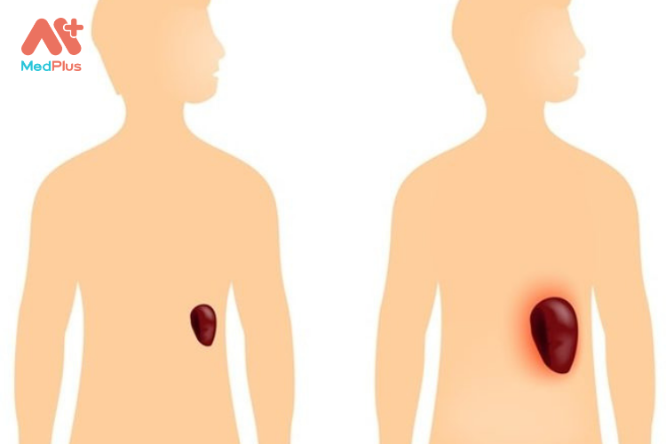 Cường lách là hội chứng gây ra do sự to lên của lách và sự sụt giảm các tế bào máu bao gồm hồng cầu và bạch cầu