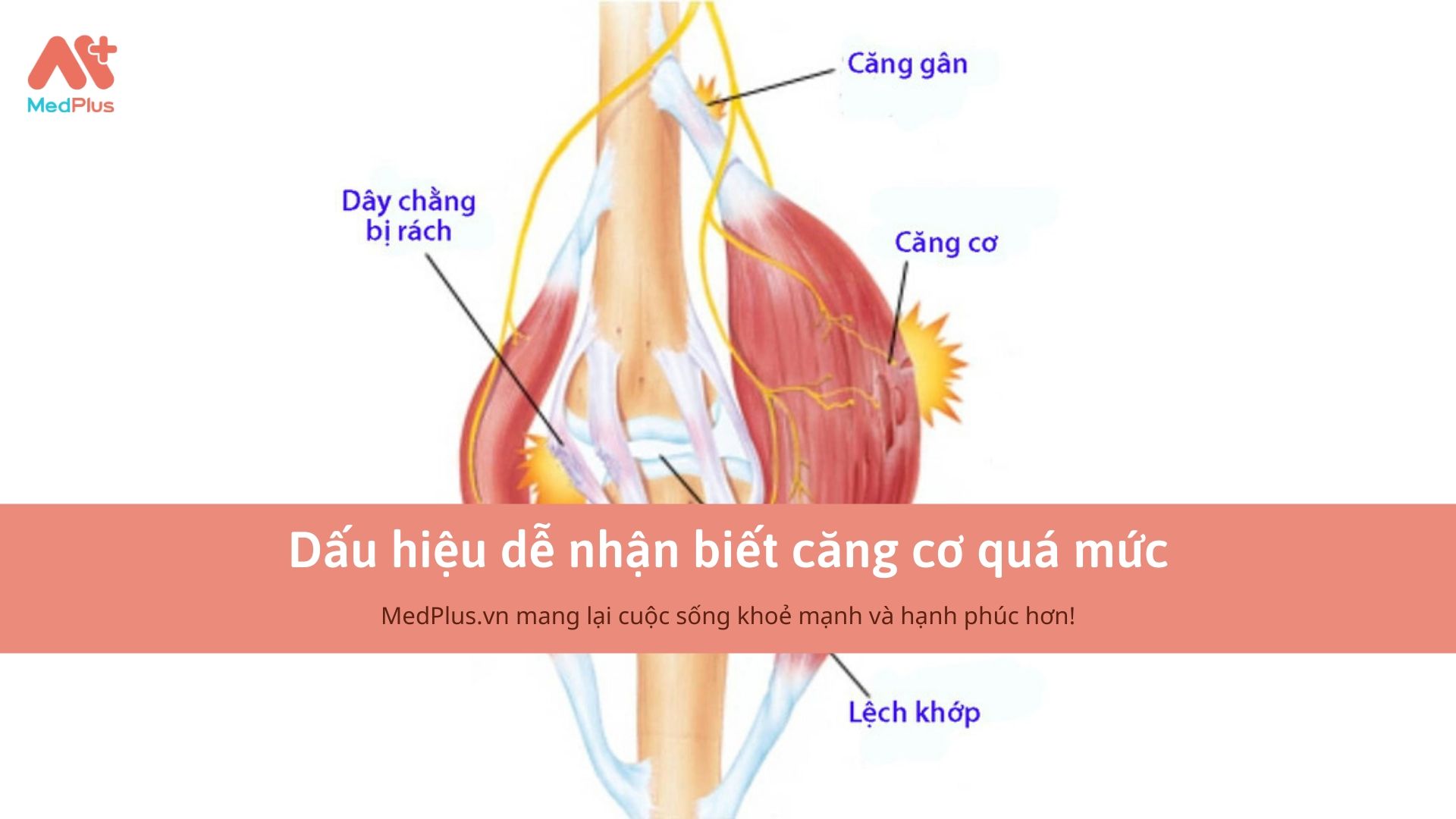 Dấu hiệu dễ nhận biết đau căng cơ quá mức