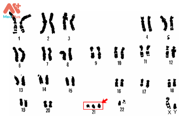 Hình ảnh nhiễm sắc thể (NST) số 21