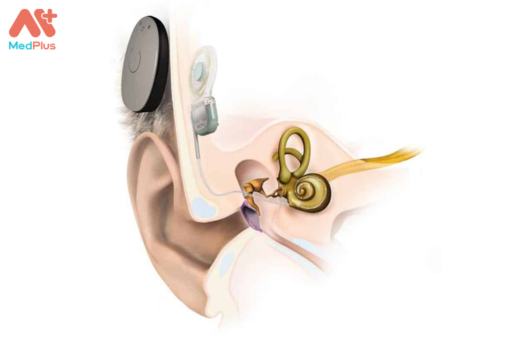 Mắc bệnh do có vấn đề ở ốc tai