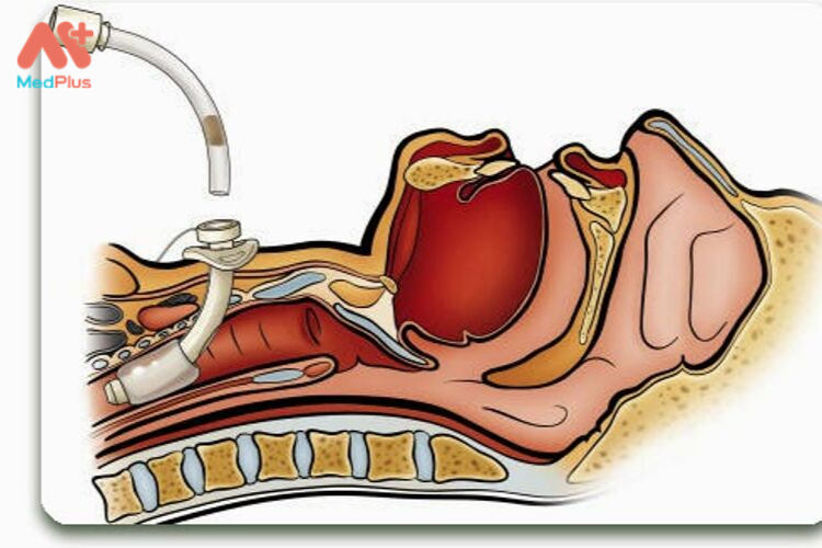 Mở khí quản là một trong những phương pháp điều trị bệnh bạch hầu