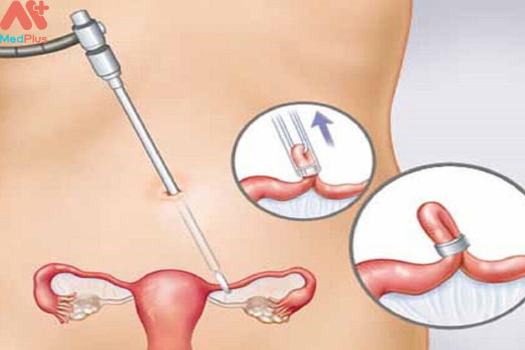 Thắt ống dẫn trứng ở nữ - phương pháp ngừa thai hiệu quả