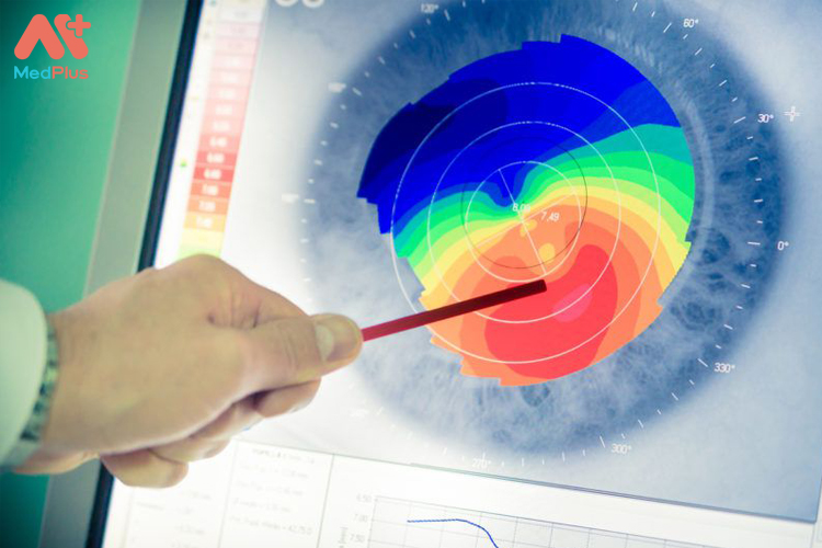 Phương pháp địa hình giác mạc giúp chẩn đoán giác mạc hình chóp