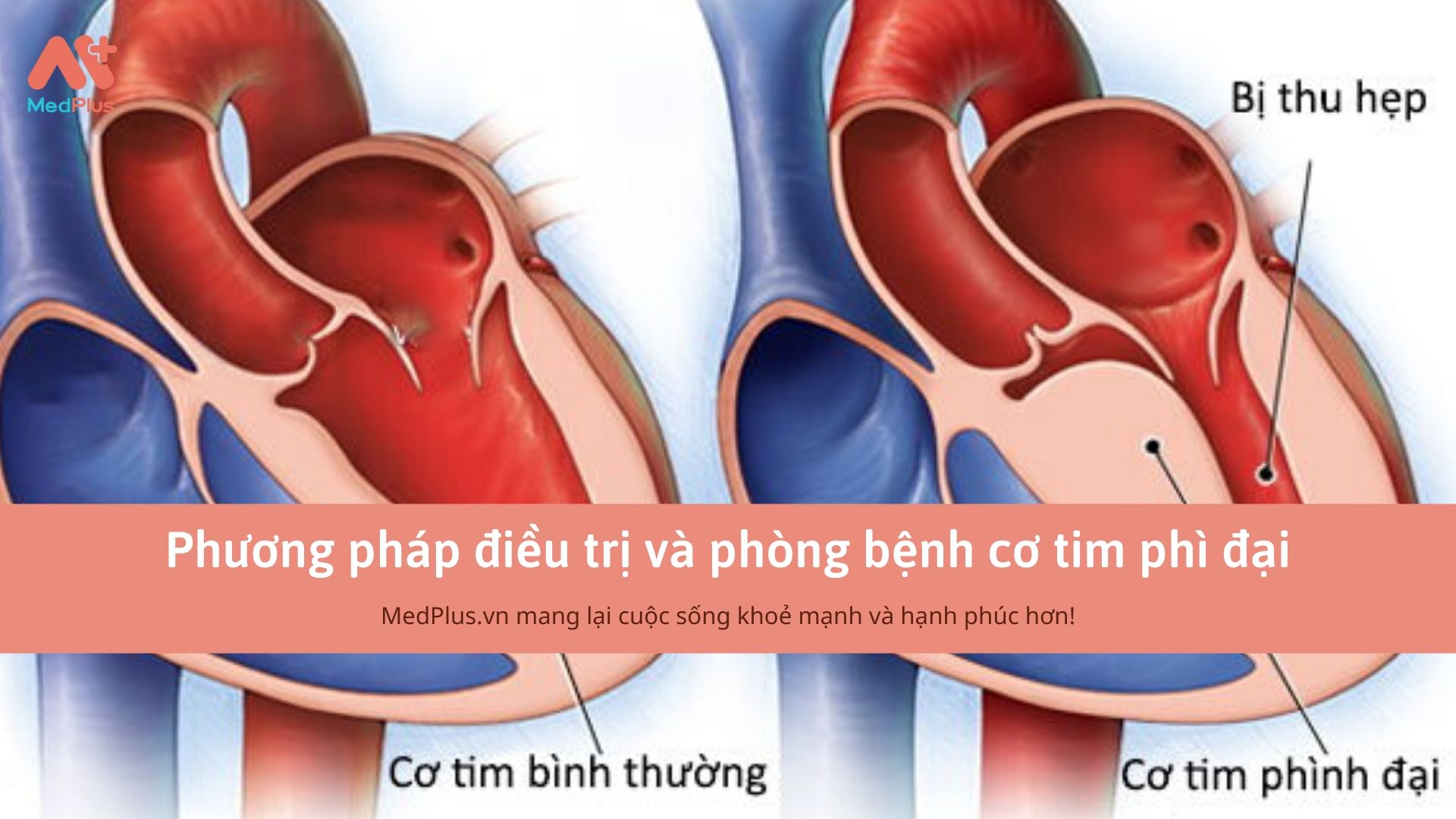 Phương pháp phòng bệnh và điều trị bệnh cơ tim phì đại 130 Phương pháp điều trị và phòng bệnh cơ tim phì đại