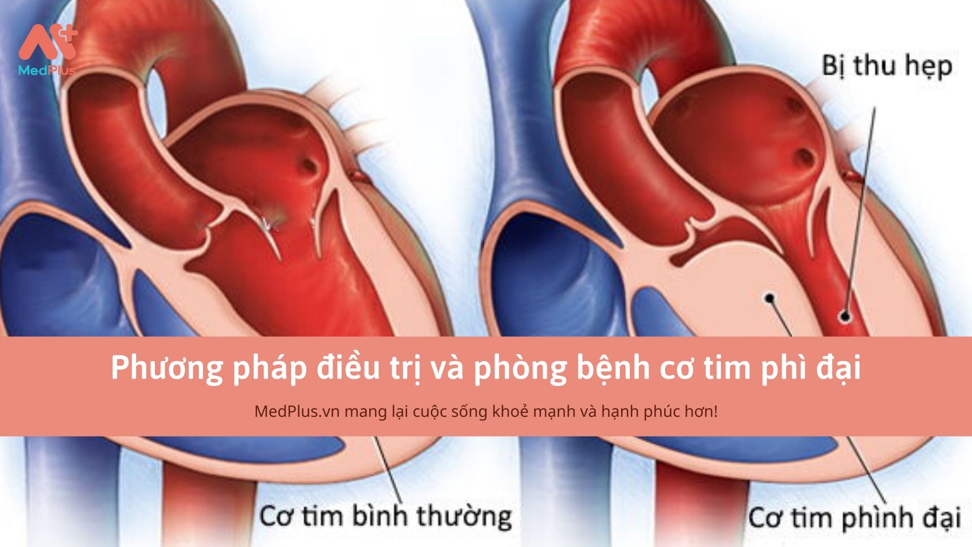 Phương pháp điều trị và phòng bệnh cơ tim phì đại