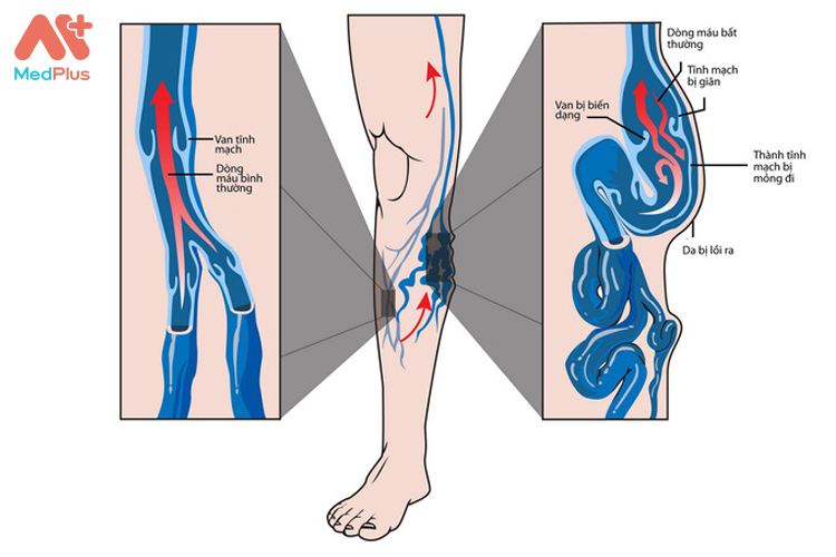 Suy giảm tĩnh mạch dưới