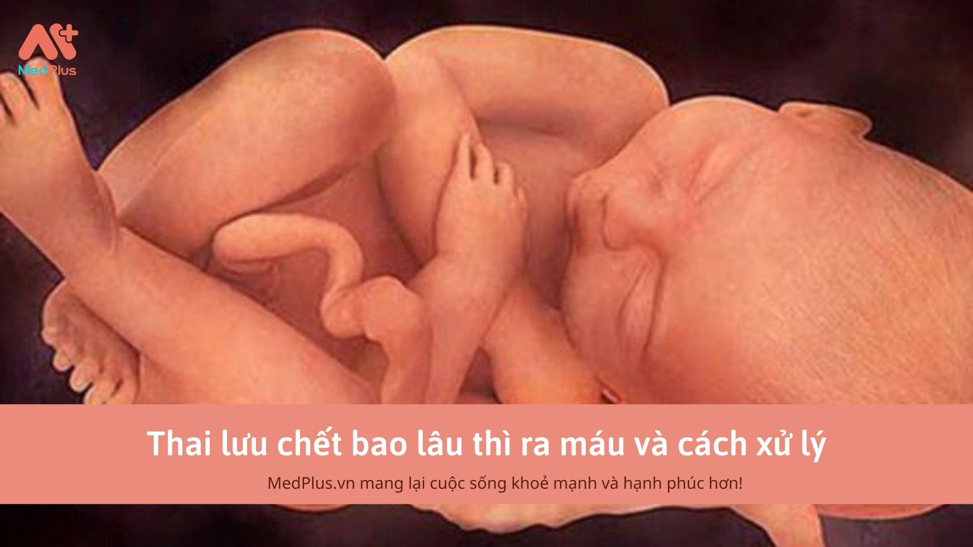 Thai lưu chết bao lâu thì ra máu và cách xử lý