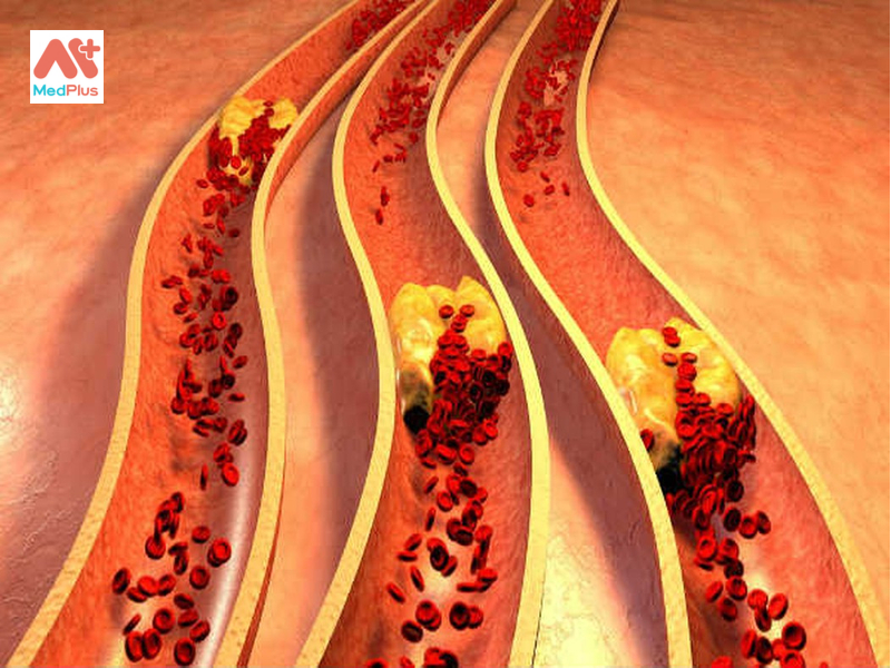 Lượng cholesterol trong máu cao gây nguy cơ mắc bệnh tim.
