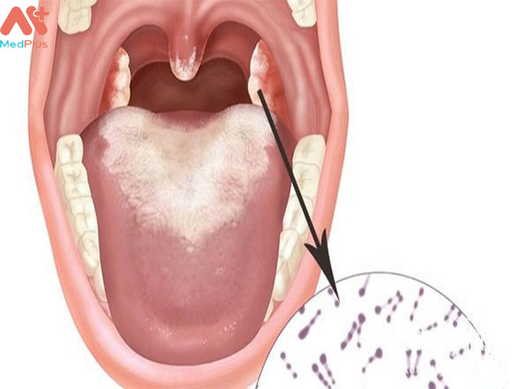 Thuốc trung hòa độc tố giúp tiêu diệu các vi khuản khu trú tại vòm họng.