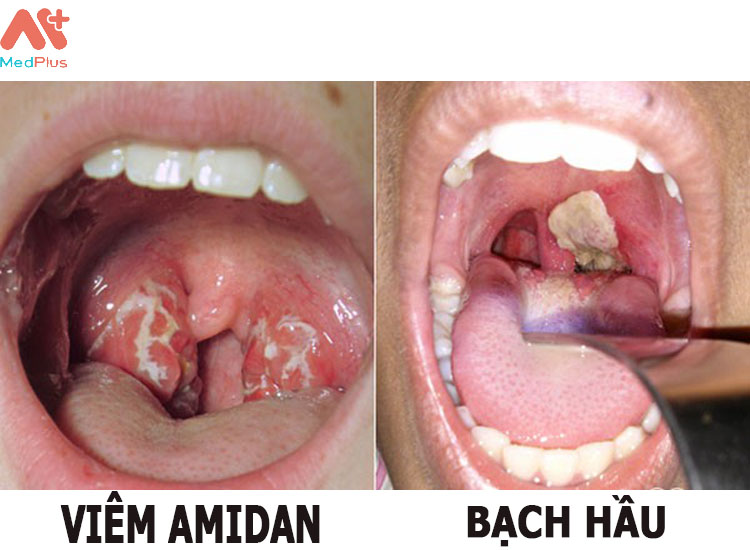 Hình ảnh phân biệt giữa bệnh Amidan và Bệnh bjach hầu