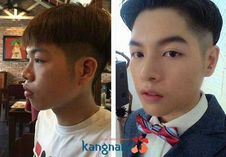 Nâng mũi đẹp BVTM Kangnam