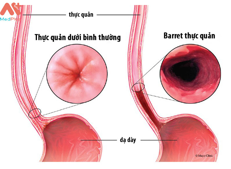Hình ảnh mô phỏng Barrett dạ dày.