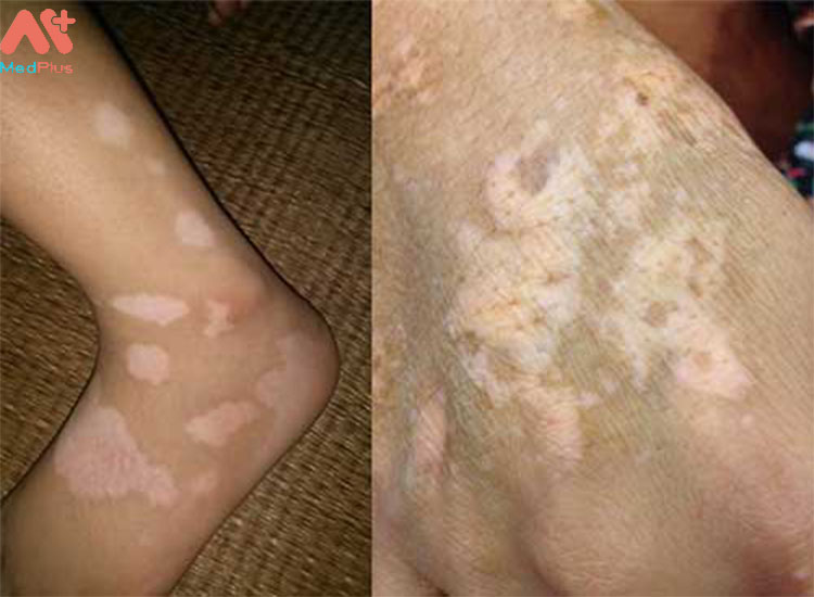 Bệnh bạch biến biểu hiện trên da là những mảng bong tróc không đều màu.