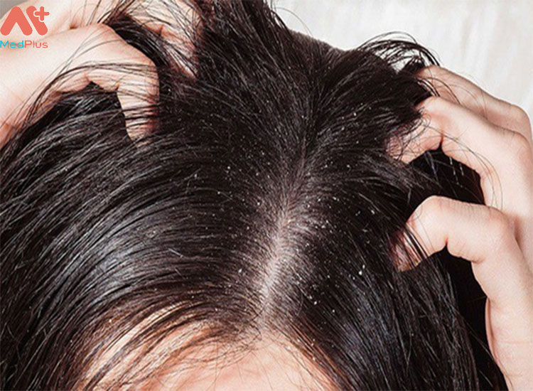 Chấy rận gây ngứa và rát da đầu.