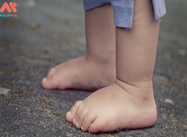 Bàn chân phẳng là một bệnh lý phổ biến ở trẻ em.