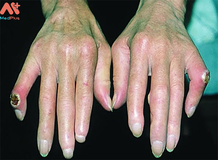 Rối loạn sắc tố da, co quắp các khớp tay là một trong những dấu hiệu của bệnh.