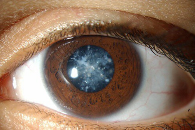 Bệnh đục thủy tinh thể hay còn gọi là đục nhân mắt, bệnh cườm đá, cườm khô.