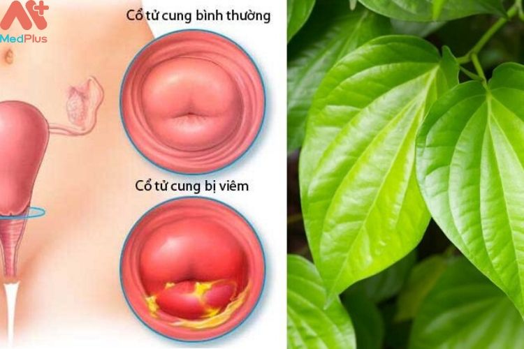 Chữa viêm cổ tử cung bằng lá trầu không