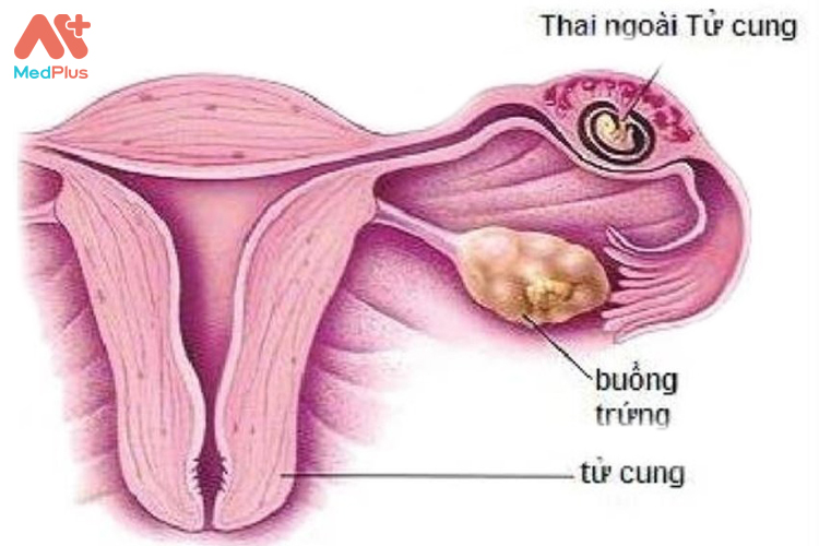 Mang thai ngoài tử cung