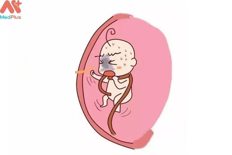 Làm gì thai nhi bị nhau thai cuốn cổ?