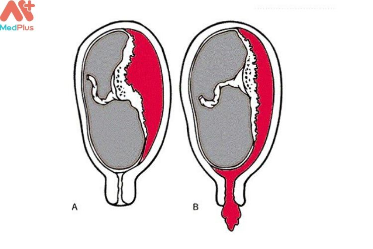 Triệu chứng xuất hiện khi nhau thai bị sót lại trong cơ thể