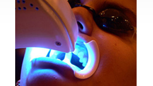 Phương pháp tẩy trắng răng tại phòng bằng đèn laser.