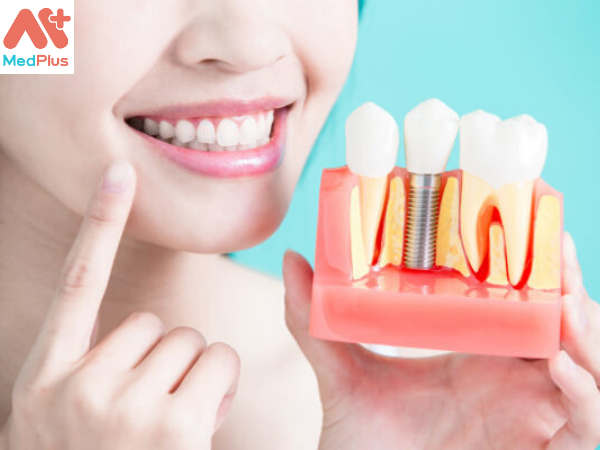 Phong khám cung cấp dịch vụ trồng răng Implant với bảng giá được niêm yết rõ ràng