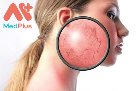 Top 5 địa chỉ điều trị da nhiễm corticoid hàng đầu quận 10 - Medplus